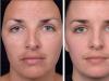 Facial peeling at home for wrinkles, skin rejuvenation