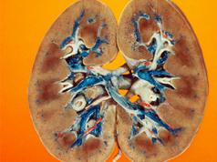 Posibilitatea de sarcină cu rinichi bolnavi Complicații ale insuficienței renale