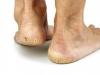 Førstehjelp for hæler: de beste kremene og salvene for sprekker Oppskrift på krem ​​for sprukne hæler
